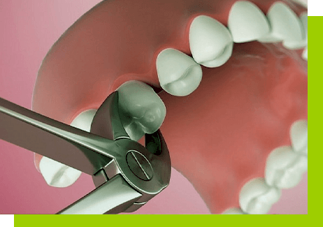 usuwanie zębów łódź