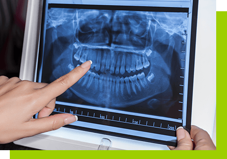 Resekcja korzeni łódź