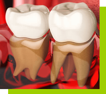 Ekstrakcja zębów łódź