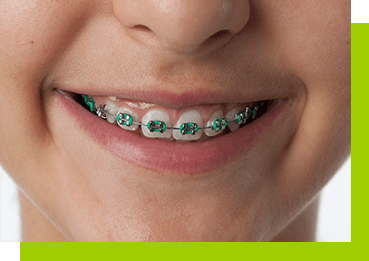 Czyszczenie zębów z aparatem ortodontycznym