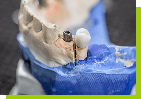 protezy na implantach