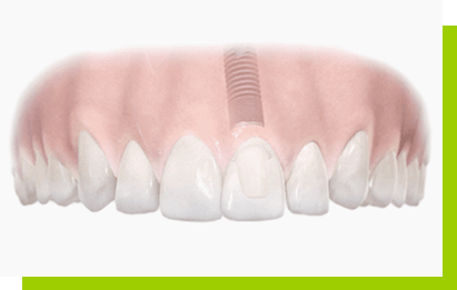 implanty zębów łódź