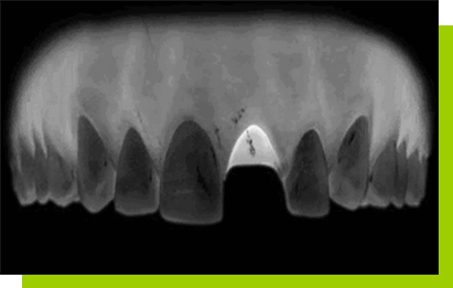 implanty łódź opinie