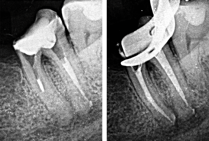 powtórne leczenie kanałowe
