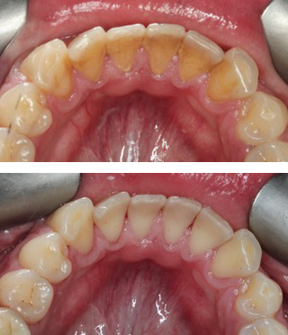 usuwanie kamienia nazębnego łódź