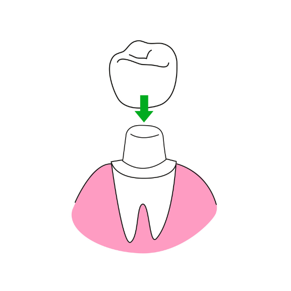 Korony i mosty zębowe
