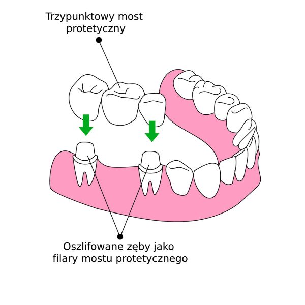 Korony i mosty zębowe